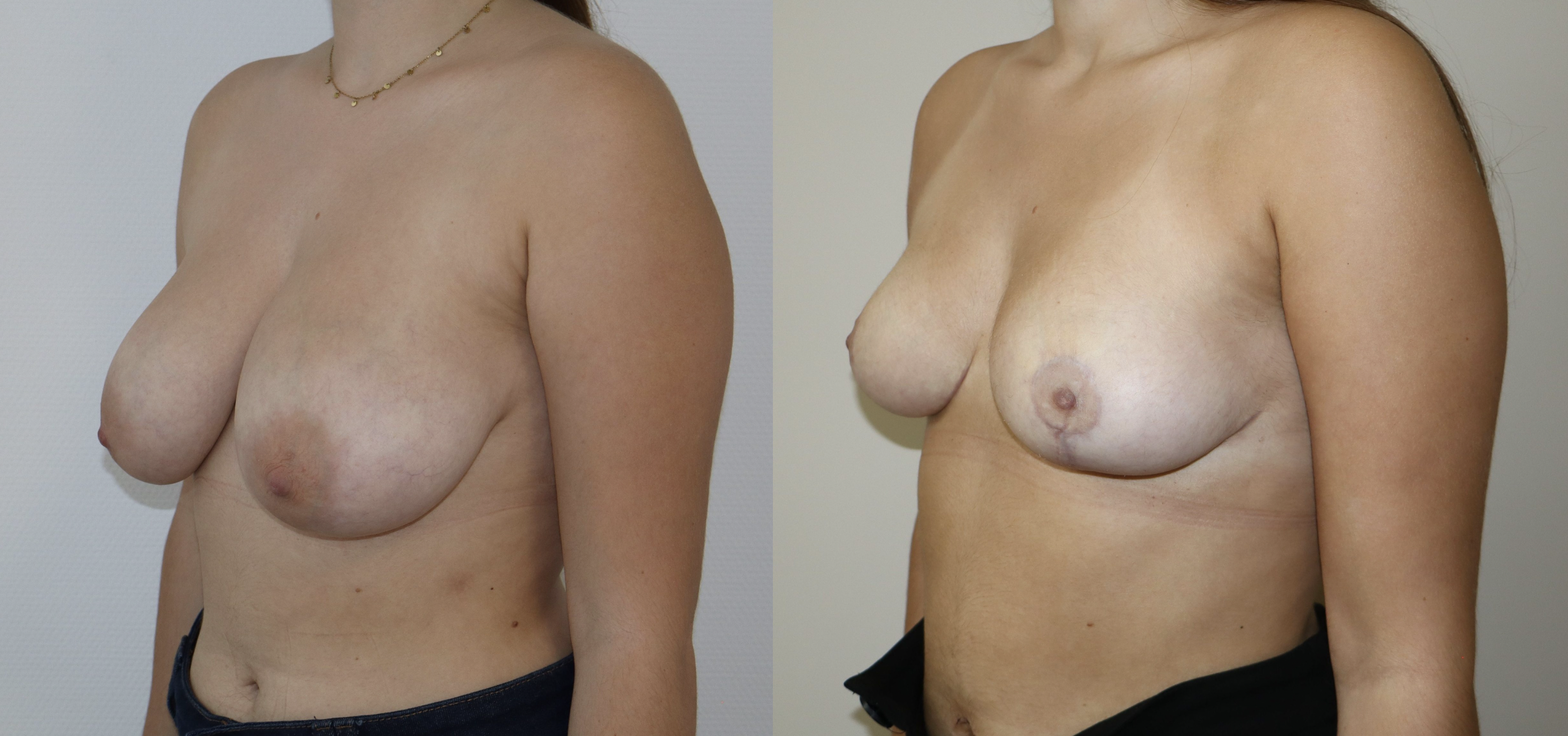 Avant/Après lifting seins et réduction mammaire